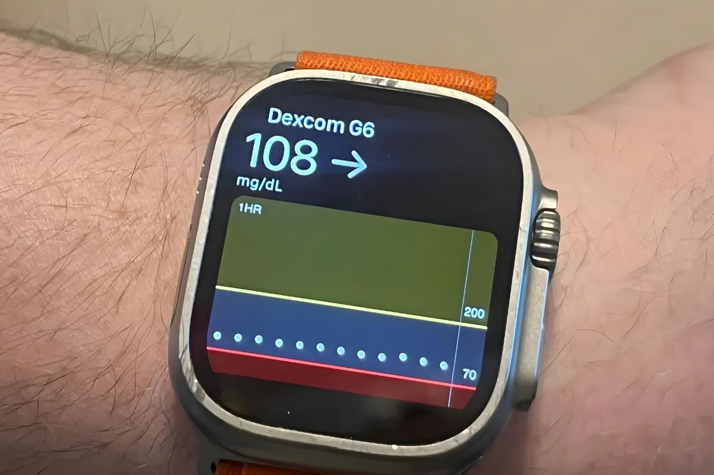 Dexcom apple watch diabete insuline