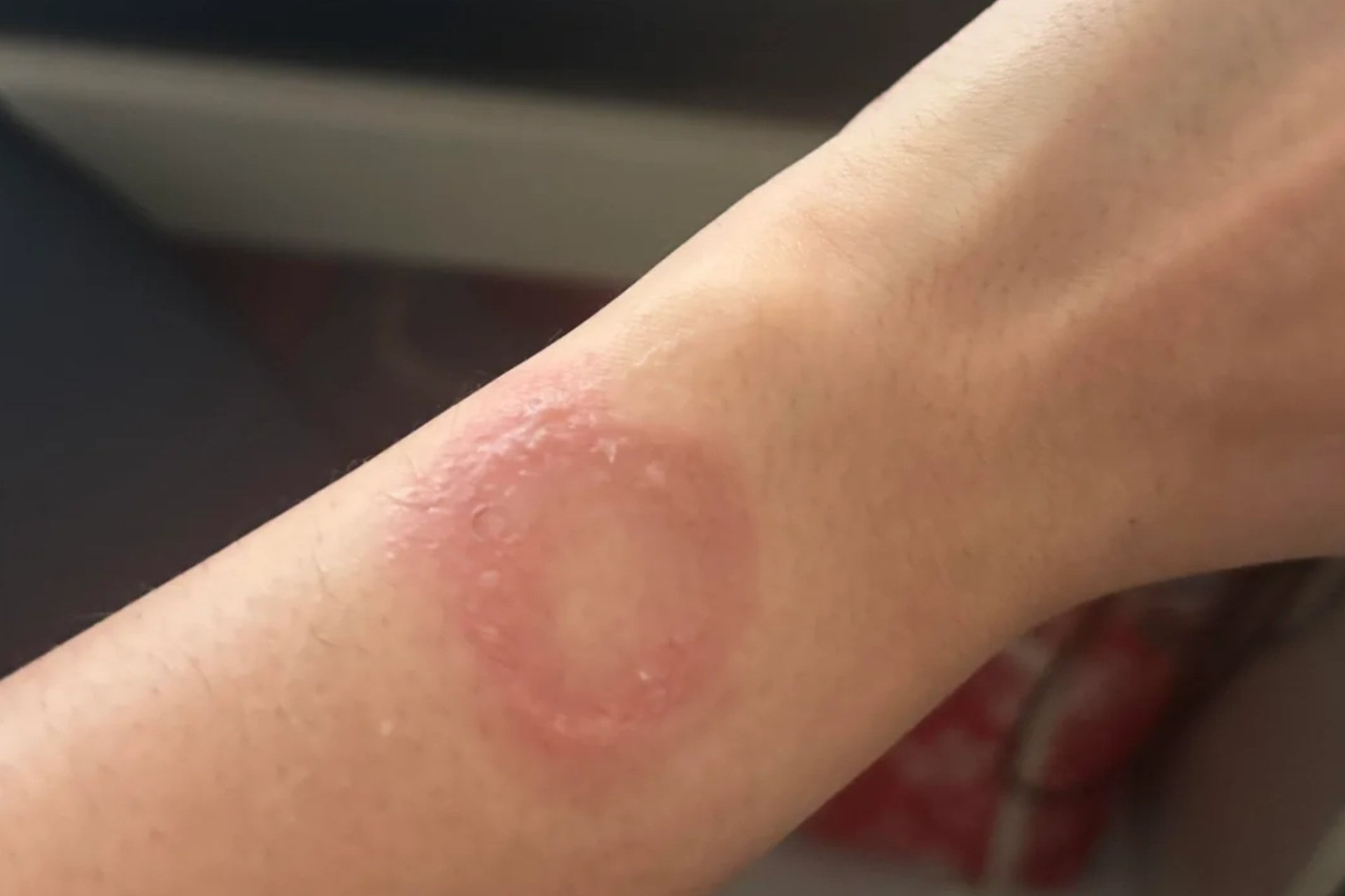 Apple watch brulure histoire